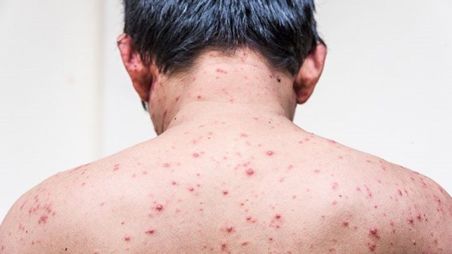 chickenpox-in-adults-722x406-wb27fcGXvt.jpg