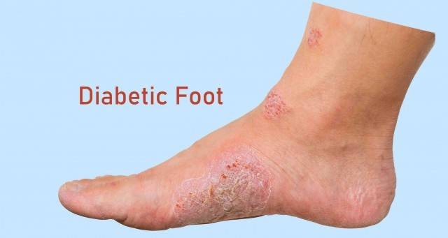 diabetic foot treatment in hyderabad-QQOTVBJgMf.jpg